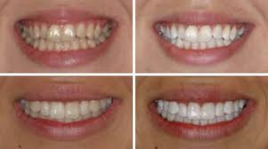 TEETH WHITENING BY XTREMELASHCANADA