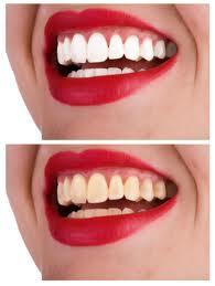   Teeth Whitening by Xtreme Beauty (Xtremeaash Canada)