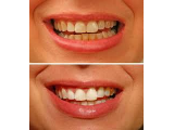 TEETH WHITENING BY XTREMELASHCANADA