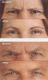 SPECIAL PRICE FOR BOTOX