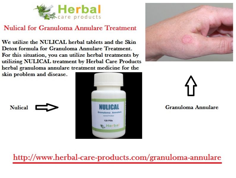 Natural Herbal Remedies for Granuloma Annulare Skin