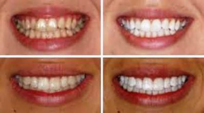 TEETH WHITENING BY XTREMELASHCANADA