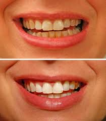 TEETH WHITENING BY XTREMELASHCANADA